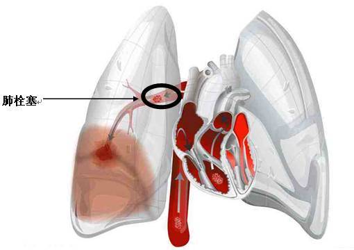 肺栓塞.jpeg