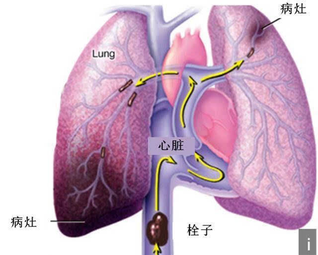 肺栓塞.jpg